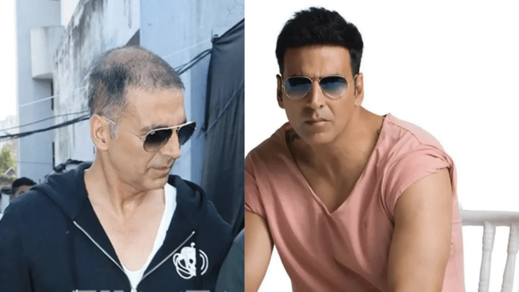 Bollywood Actors hair transplant 