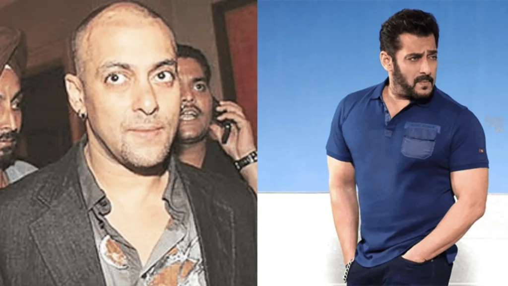 Bollywood Actors hair transplant 